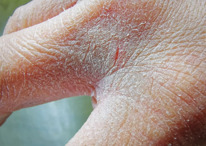 Primer plano de la piel seca y agrietada del dorso de una mano, que muestra descamación y enrojecimiento visibles -síntomas en la piel que pueden indicar irritación o deshidratación-.